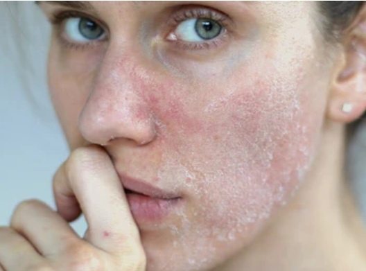 Closeup of a woman's face with red, flaky, over-exfoliated skin