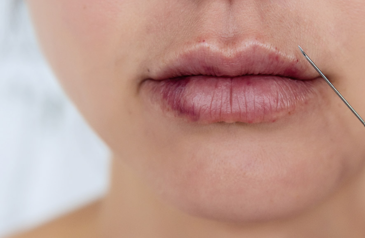 Closeup of lips with bruising after an injection, a possible sign of vascular occlusion