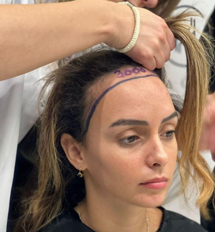 Patient hairline marked before a female hair transplant