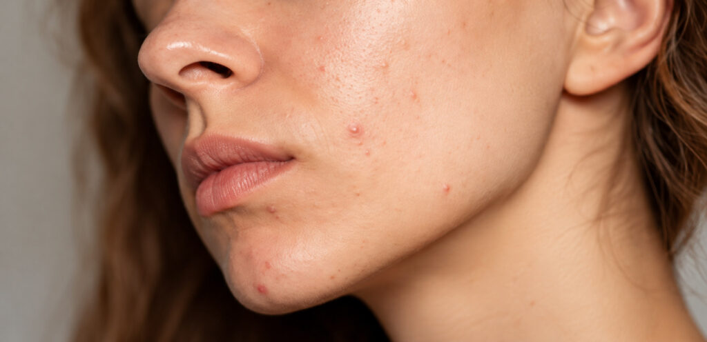 Close-up of the side of a woman's face with small blemishes and redness