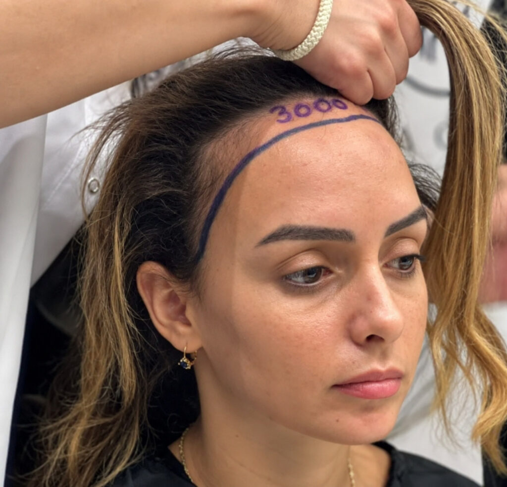 Woman with her planned hairline drawn on the forehead before a hair transplant