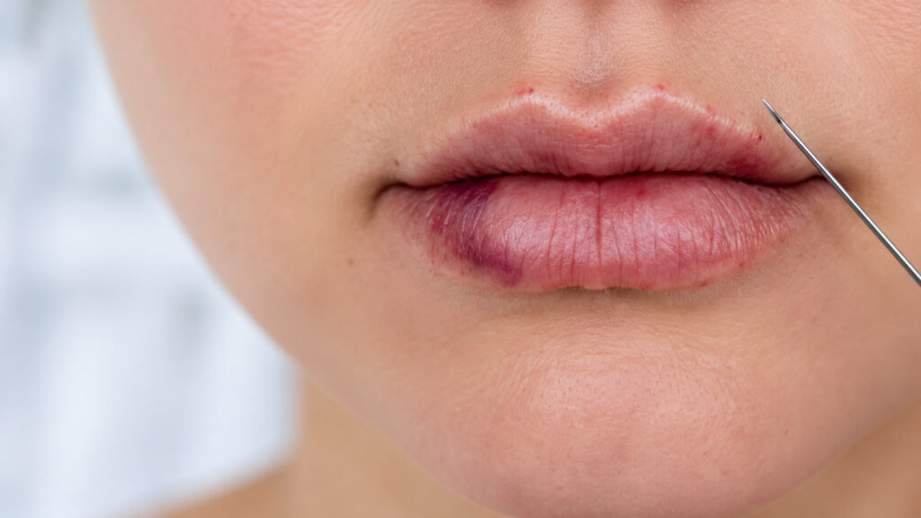 Close-up of lips with bruising and pale patches beside a cannula after a filler injection