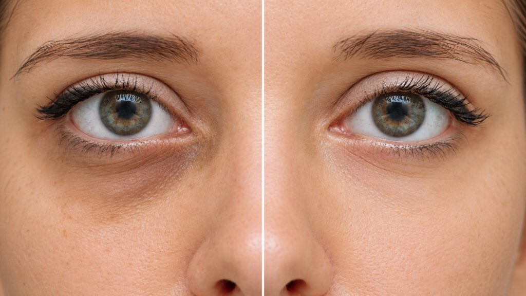 Close-up of a woman's eyes split down the middle to compare the skin around them